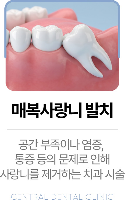 센트럴치과 매복사랑니 발치, 공간 부족·염증·통증에 따른 발치 안내