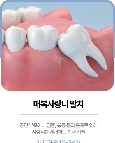 센트럴치과 매복사랑니 발치, 공간 부족·염증·통증에 따른 발치 안내