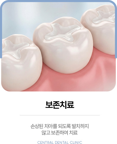 센트럴치과 보존치료, 손상된 치아를 발치하지 않고 보존하는 치료