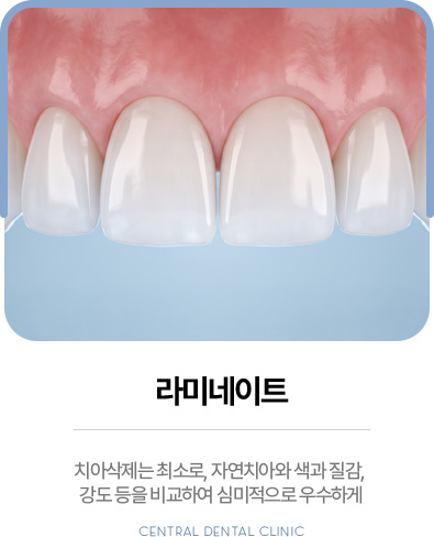 센트럴치과 라미네이트, 최소 삭제를 고려한 심미치료